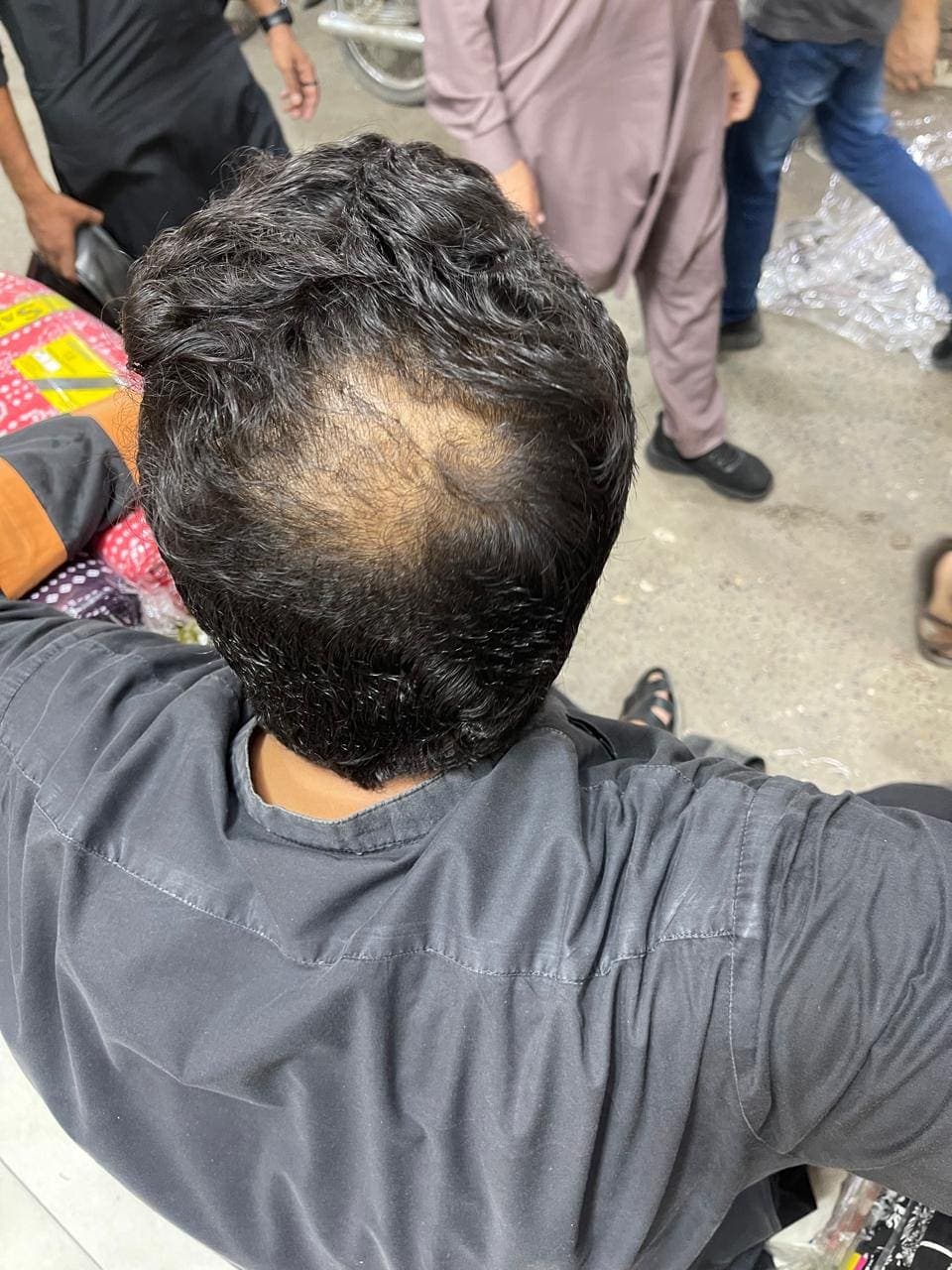 Customer's hair before using ZeeNix